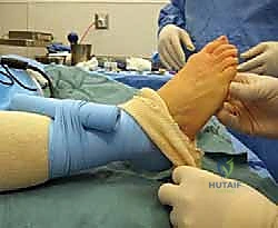 ظهور النتوء العظمي والتورم أعلى مفصل إبهام القدم