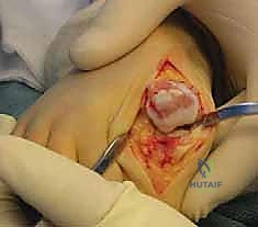 أمثلة على الأحذية الطبية والنعال المستخدمة في العلاج التحفظي