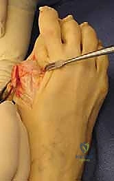 تثبيت مفصل إبهام القدم الكبير الحل النهائي لآلام إبهام القدم المتيبس مع الأستاذ الدكتور محمد هطيف