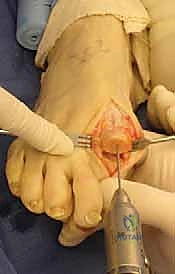 مقارنة بين إبهام القدم الطبيعي وإبهام القدم المتيبس