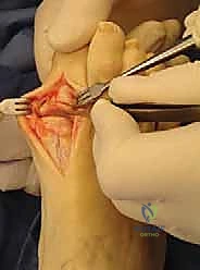 صورة توضيحية لـ تثبيت مفصل إبهام القدم الكبير الحل النهائي لآلام إبهام القدم المتيبس مع الأستاذ الدكتور محمد هطيف