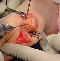 صورة توضح التئام الجرح الجراحي بشكل ممتاز بعد أسابيع من العملية