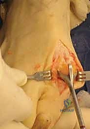 تشريح مفصل إبهام القدم الكبير والأربطة المحيطة به