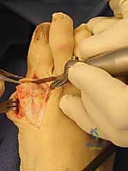 صورة شعاعية بعد العملية توضح التثبيت المثالي لشريحة التيتانيوم