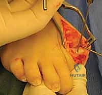 عمل الشق الجراحي الدقيق للوصول إلى المفصل المشطي السلامي