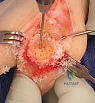 إزالة الغضروف التالف وإعداد الأسطح العظمية للدمج