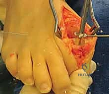 تثبيت المفصل باستخدام شريحة التيتانيوم والمسامير الضاغطة