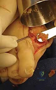 صورة توضيحية لـ تثبيت مفصل إبهام القدم الكبير الحل النهائي لآلام إبهام القدم المتيبس مع الأستاذ الدكتور محمد هطيف