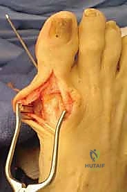 تجهيز المريض وتعقيم منطقة القدم قبل بدء التدخل الجراحي