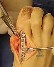 مقارنة بين أنواع الجراحات المختلفة لمفصل إبهام القدم