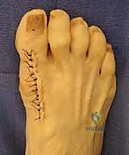 المريض يستخدم الحذاء الطبي المخصص لفترة ما بعد الجراحة