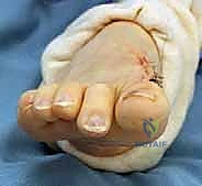 الدكتور محمد هطيف يقوم بفحص مدى حركة مفصل الإبهام للمريض