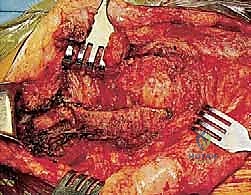 تثبيت مفصل الكتف (Glenohumeral Arthrodesis): حل إنقاذي متقدم لاستعادة وظيفة الذراع بإشراف الأستاذ الدكتور محمد هطيف