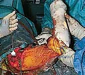 صورة توضيحية لـ تثبيت مفصل الكتف (Glenohumeral Arthrodesis): حل إنقاذي متقدم لاستعادة وظيفة الذراع بإشراف الأستاذ الدكتور محمد هطيف