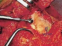 التشريح الدقيق لمفصل الكتف والأسطح الاندماجية في جراحة تثبيت الكتف