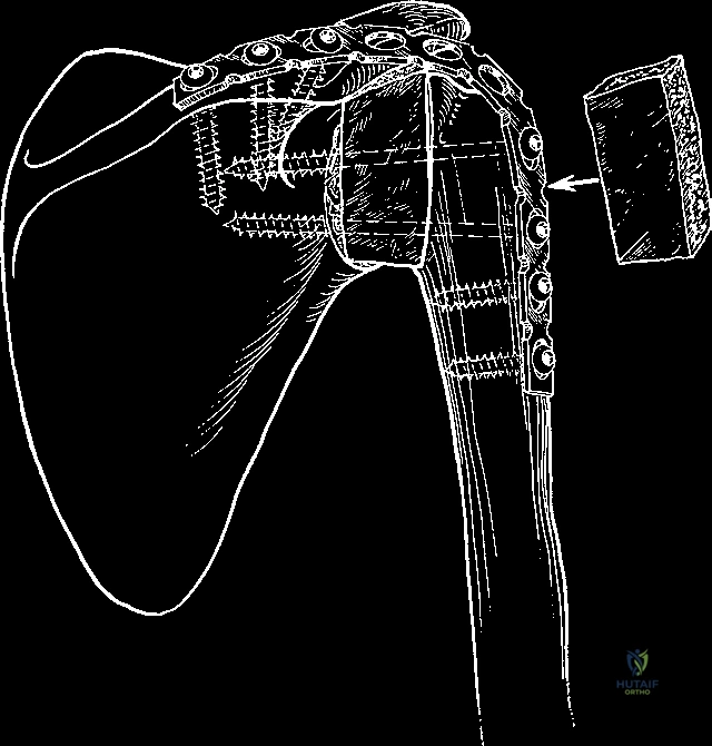برنامج التأهيل والعلاج الطبيعي بعد جراحة تثبيت مفصل الكتف لضمان أفضل النتائج