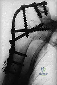 خطوات الجراحة الدقيقة لتثبيت مفصل الكتف باستخدام الصفائح والمسامير المعدنية