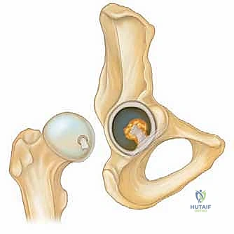 صورة توضيحية لـ منظار الورك: دليلك الشامل لعلاج آلام مفصل الورك المعقدة مع الأستاذ الدكتور محمد هطيف في صنعاء
