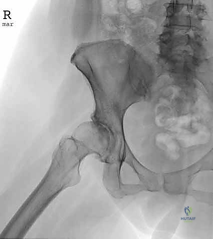 صورة توضيحية لـ منظار الورك: دليلك الشامل لعلاج آلام مفصل الورك المعقدة مع الأستاذ الدكتور محمد هطيف في صنعاء