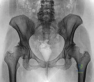 صورة توضيحية لـ منظار الورك: دليلك الشامل لعلاج آلام مفصل الورك المعقدة مع الأستاذ الدكتور محمد هطيف في صنعاء