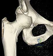 منظار الورك: دليلك الشامل لعلاج آلام مفصل الورك المعقدة مع الأستاذ الدكتور محمد هطيف في صنعاء