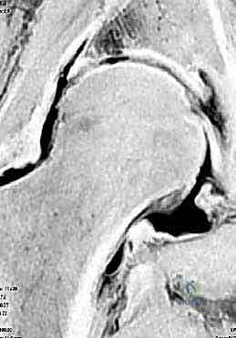 صورة توضيحية لـ منظار الورك: دليلك الشامل لعلاج آلام مفصل الورك المعقدة مع الأستاذ الدكتور محمد هطيف في صنعاء