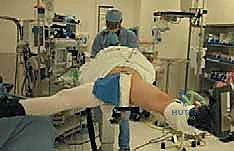 تحرير الأوتار عبر المنظار