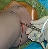 النتيجة النهائية للشقوق الجراحية