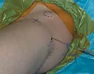 إغلاق الجروح الجراحية