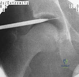 رؤية واضحة للغضروف عبر المنظار