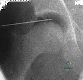 خياطة الشفا الغضروفي الممزق