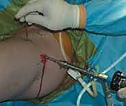 إصلاح الاصطدام الفخذي الحقي