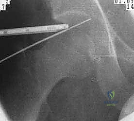 نقاش الخطة الجراحية
