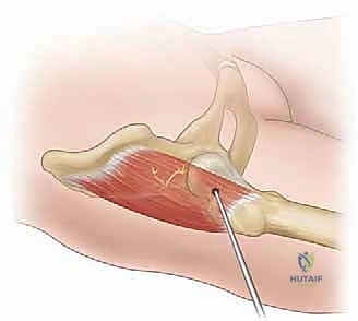 إدخال المنظار والأدوات الجراحية
