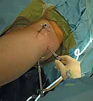 تمارين التأهيل ما بعد الجراحة