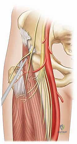 تجهيز المريض على طاولة العمليات