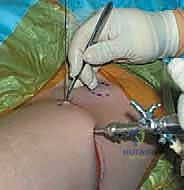 Intraoperative Surgical Step