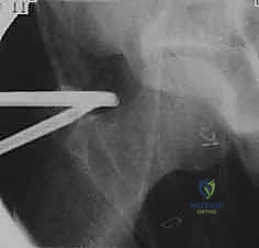 صورة تظهر الشقوق الجراحية الدقيقة