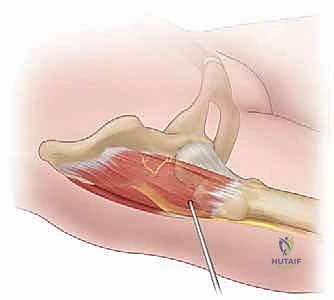نحت العظام الزائدة بالمنظار