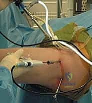 Illustration of arthroscopy the basics - Dr. Mohammed Hutaif