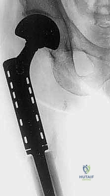 صورة طبية: استئصال عظم الفخذ وإعادة البناء بالطرف الاصطناعي: دليل شامل للمرضى مع الأستاذ الدكتور محمد هطيف في صنعاء