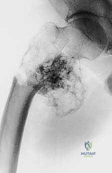 صورة طبية: استئصال عظم الفخذ وإعادة البناء بالطرف الاصطناعي: دليل شامل للمرضى مع الأستاذ الدكتور محمد هطيف في صنعاء