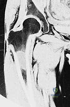 صورة طبية: استئصال عظم الفخذ وإعادة البناء بالطرف الاصطناعي: دليل شامل للمرضى مع الأستاذ الدكتور محمد هطيف في صنعاء