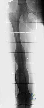 صورة طبية: استئصال عظم الفخذ وإعادة البناء بالطرف الاصطناعي: دليل شامل للمرضى مع الأستاذ الدكتور محمد هطيف في صنعاء