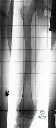 صورة طبية: استئصال عظم الفخذ وإعادة البناء بالطرف الاصطناعي: دليل شامل للمرضى مع الأستاذ الدكتور محمد هطيف في صنعاء