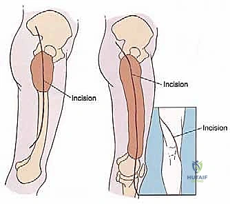 تخطيط بالأشعة المقطعية لتحديد حجم التلف العظمي