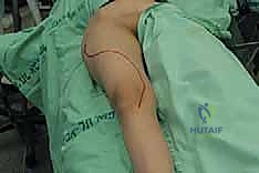 صورة شعاعية توضح ورماً خبيثاً في عظم الفخذ