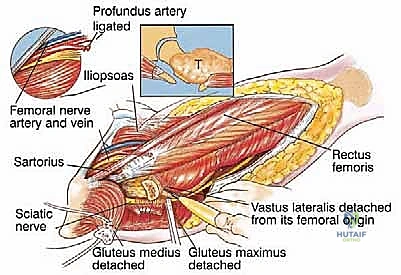 صورة طبية: استئصال عظم الفخذ وإعادة البناء بالطرف الاصطناعي: دليل شامل للمرضى مع الأستاذ الدكتور محمد هطيف في صنعاء