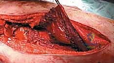 صورة طبية: استئصال عظم الفخذ وإعادة البناء بالطرف الاصطناعي: دليل شامل للمرضى مع الأستاذ الدكتور محمد هطيف في صنعاء