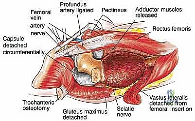 صورة طبية: استئصال عظم الفخذ وإعادة البناء بالطرف الاصطناعي: دليل شامل للمرضى مع الأستاذ الدكتور محمد هطيف في صنعاء